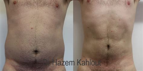 Buccal <strong>fat pad removal</strong> is an in. . Male pubic fat pad removal before and after pictures